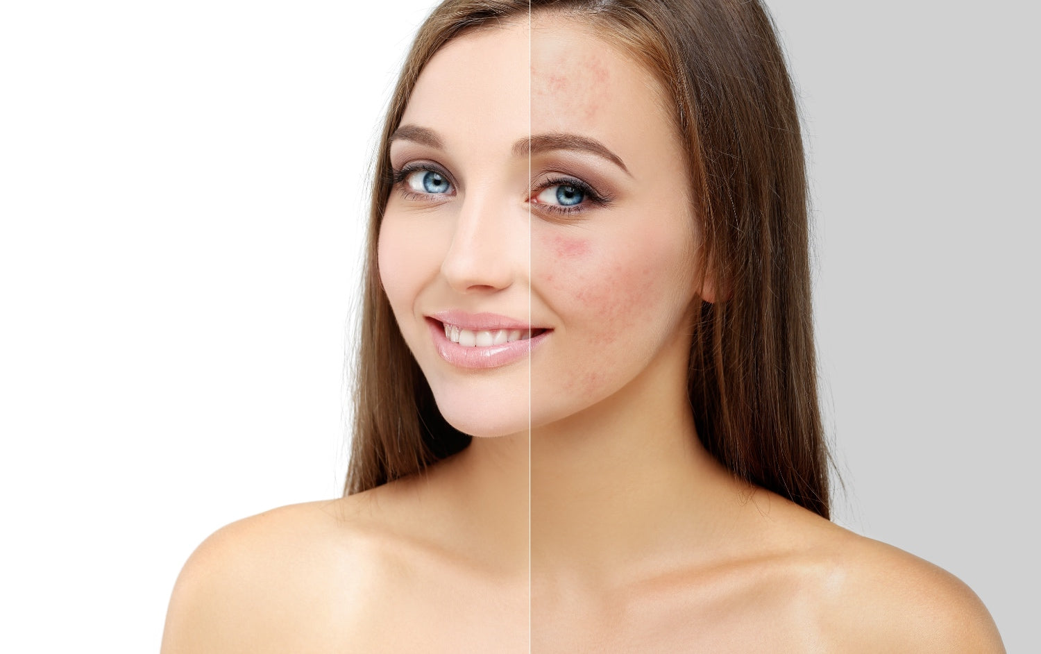 Psoriáza, ekzémy a rosacea